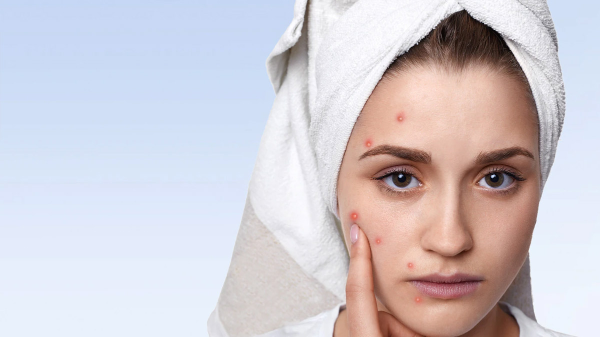 Besan For Pimples In Hindi