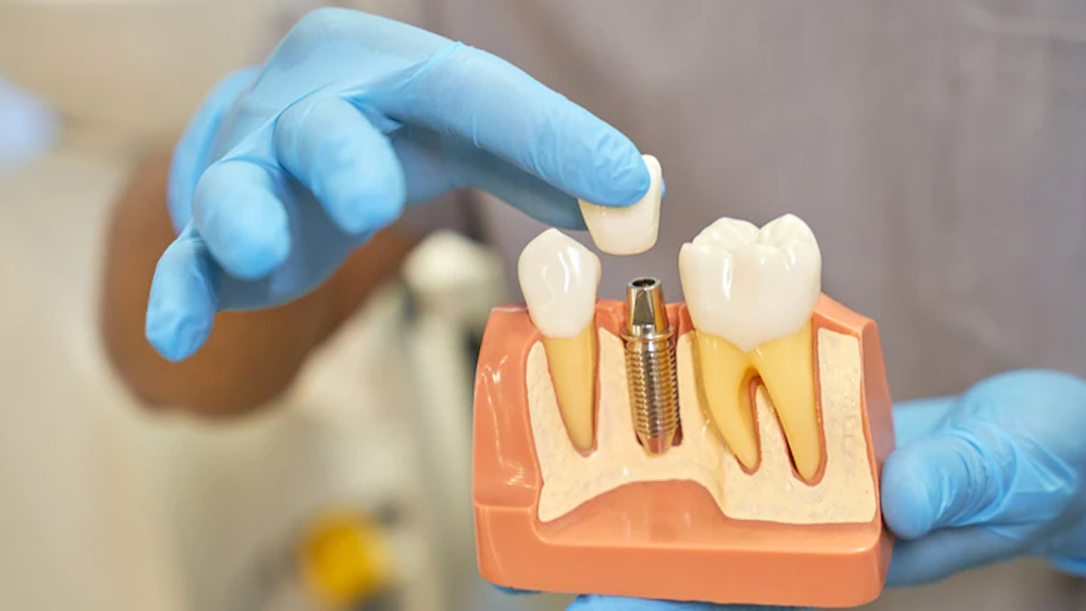 Debunking Myths About Dental Implants