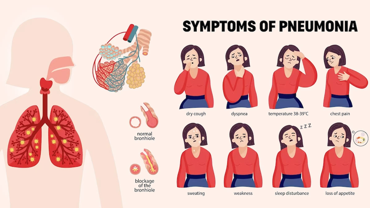 What Causes Pneumonia And How Serious Is It OnlyMyHealth