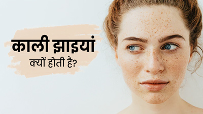 Black Freckles Causes:  काली झाइयां क्यों होती है? जानें, कारण और बचाव के उपाय 
