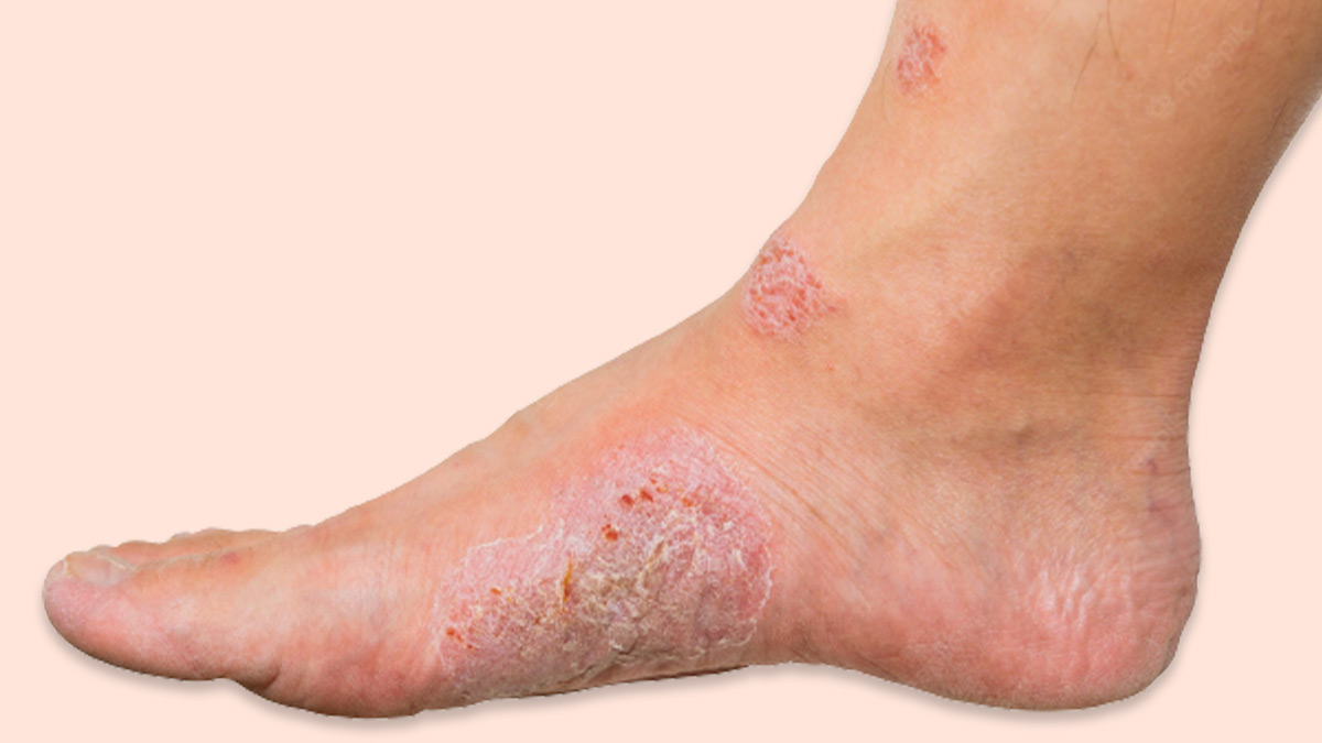 Diabetic Foot Ulcers: Symptoms, Causes, Types, Diagnosis, & Treatment ...