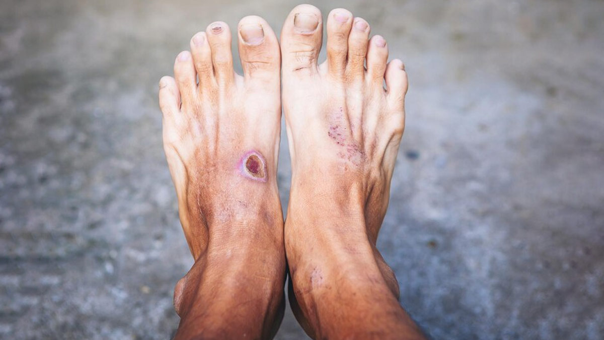 Diabetic Foot Ulcers: Symptoms, Causes, Types, Diagnosis, & Treatment