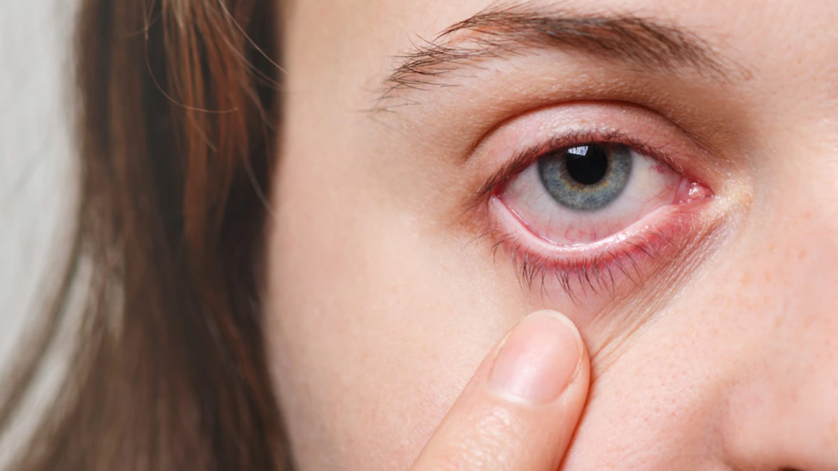 What Causes Dry Eyes In Winter & How Can You Prevent It