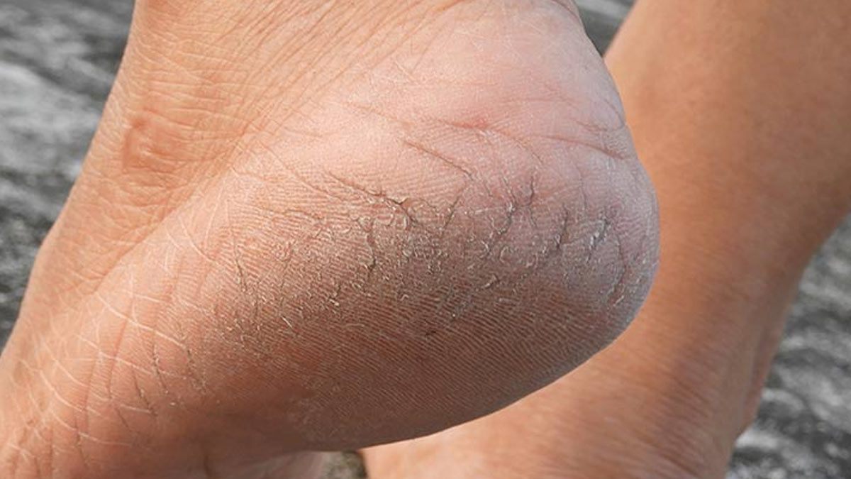 cracked heel problem 