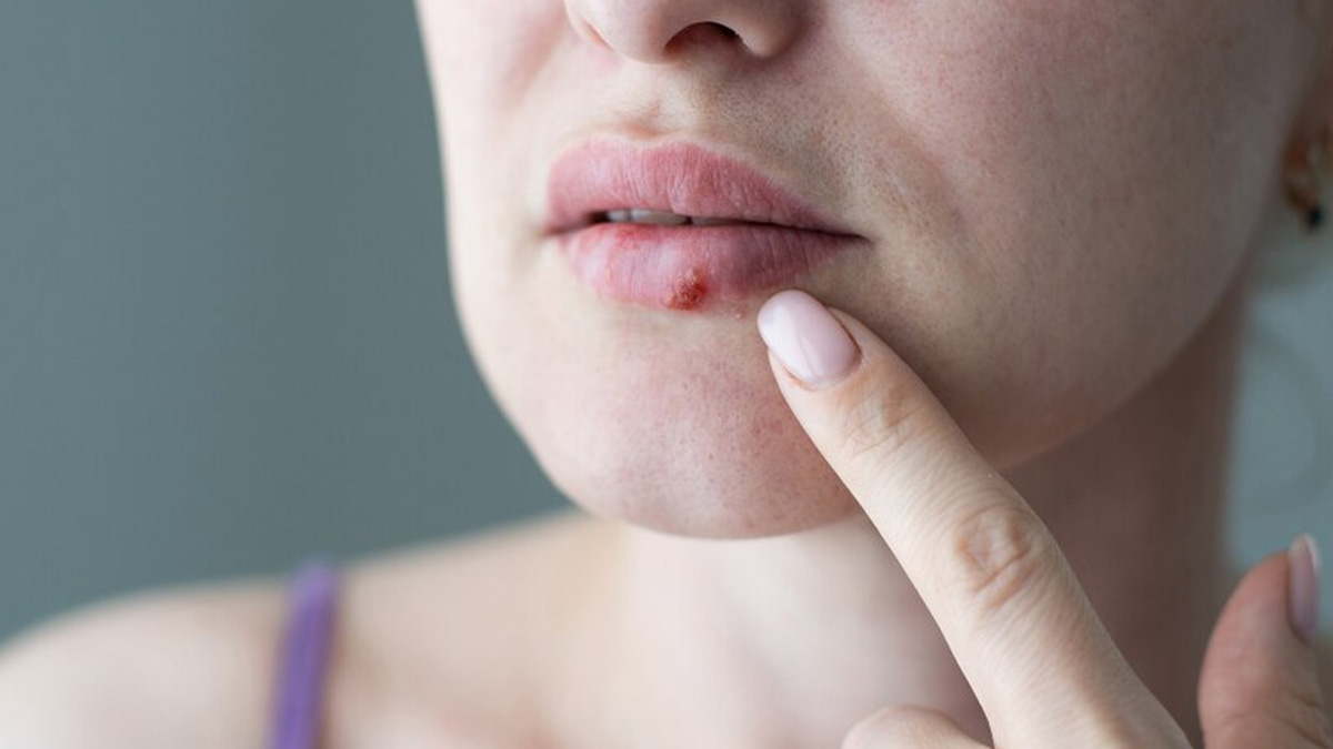 Expert Explains Difference Between Cold Sores And Canker Sores Onlymyhealth 