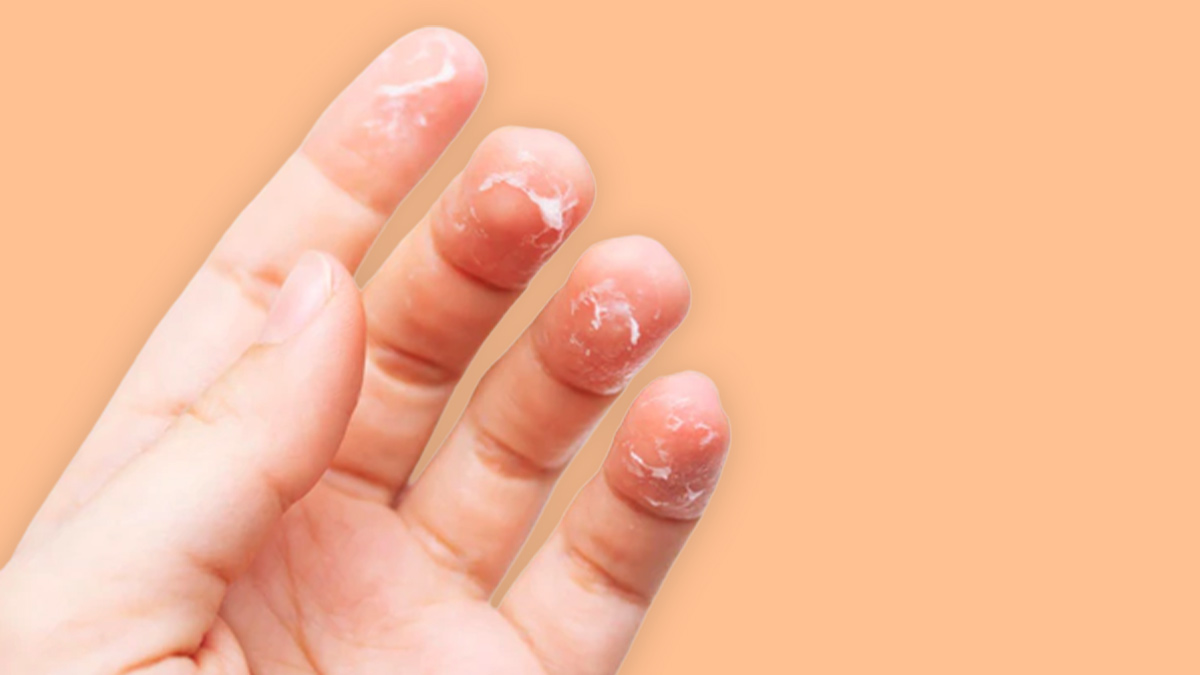 Skin Peeling At Fingertips: Ayurvedic Remedies To Treat It