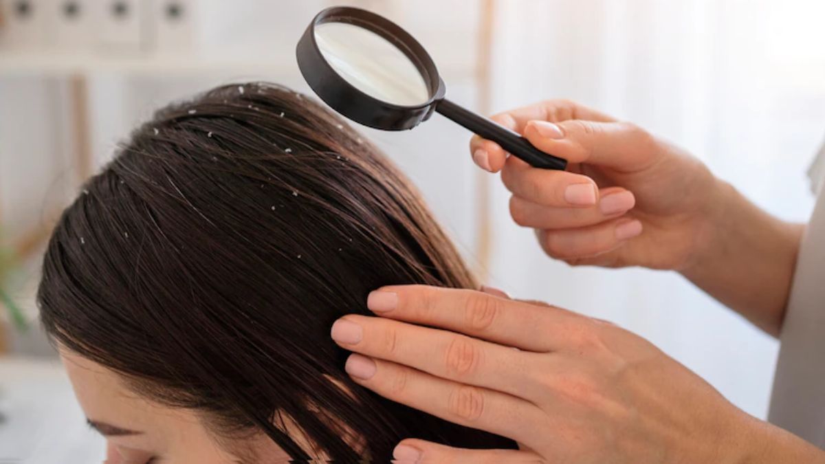 dandruff in hindi