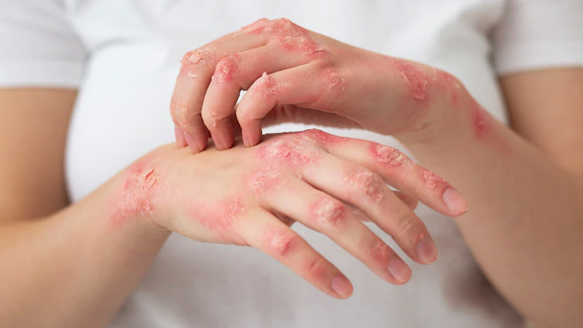 Psoriasis Expert Explains Symptoms Complications And Treatment Options Onlymyhealth 