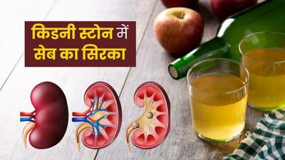किडनी स्टोन की समस्या में ऐसे करें सेब के सिरके का इस्तेमाल, खत्म होगी पथरी