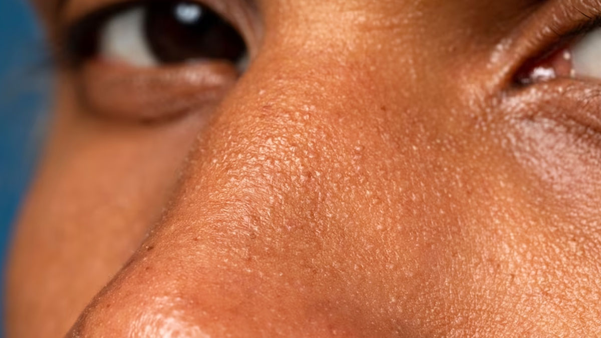 Enlarged Pores Men