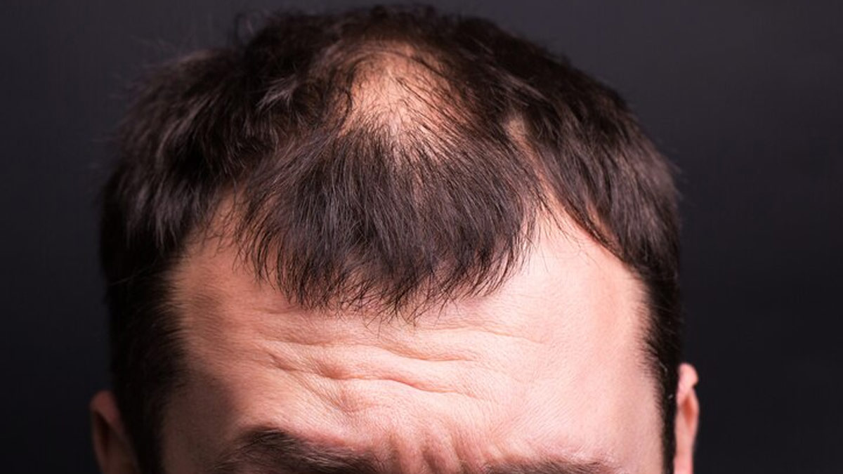  Ayurvedic Remedies To Treat Bald Patches