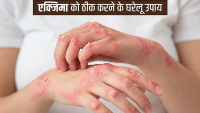 एक्जिमा की समस्या से छुटकारा पाने के लिए आजमाएं ये 5 घरेलू उपाय