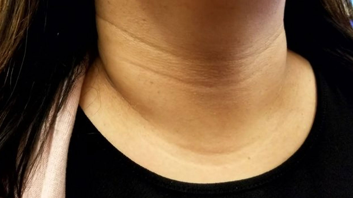 गर्दन पर धारियां (Neck Lines) क्यों बन जाती हैं? जानें इसके कारण और घरेलू उपाय neck lines