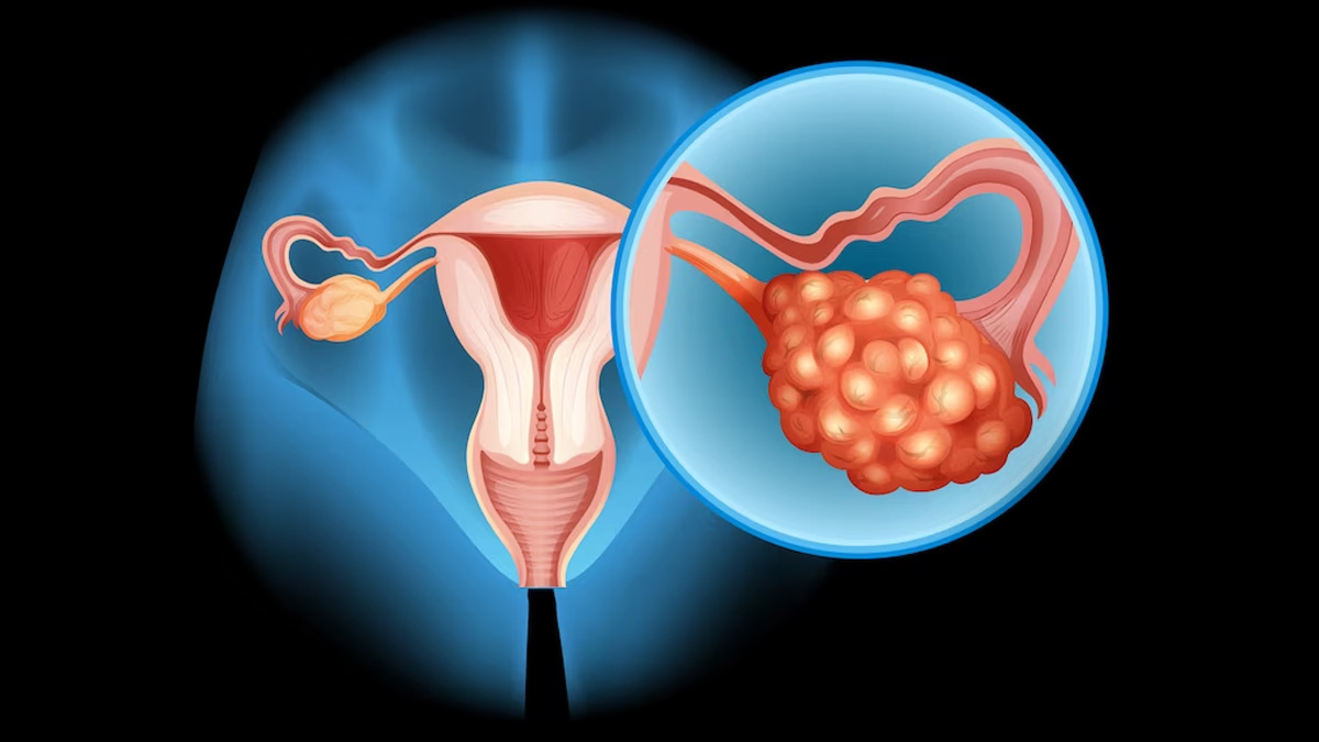 from-menstrual-cramps-to-fibroids-causes-of-lower-abdominal-pain-in