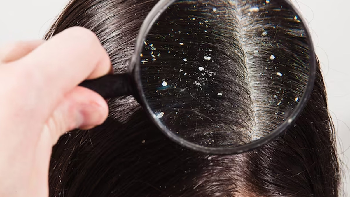 Baking Soda And Lemon To Remove Dandruff In Hindi