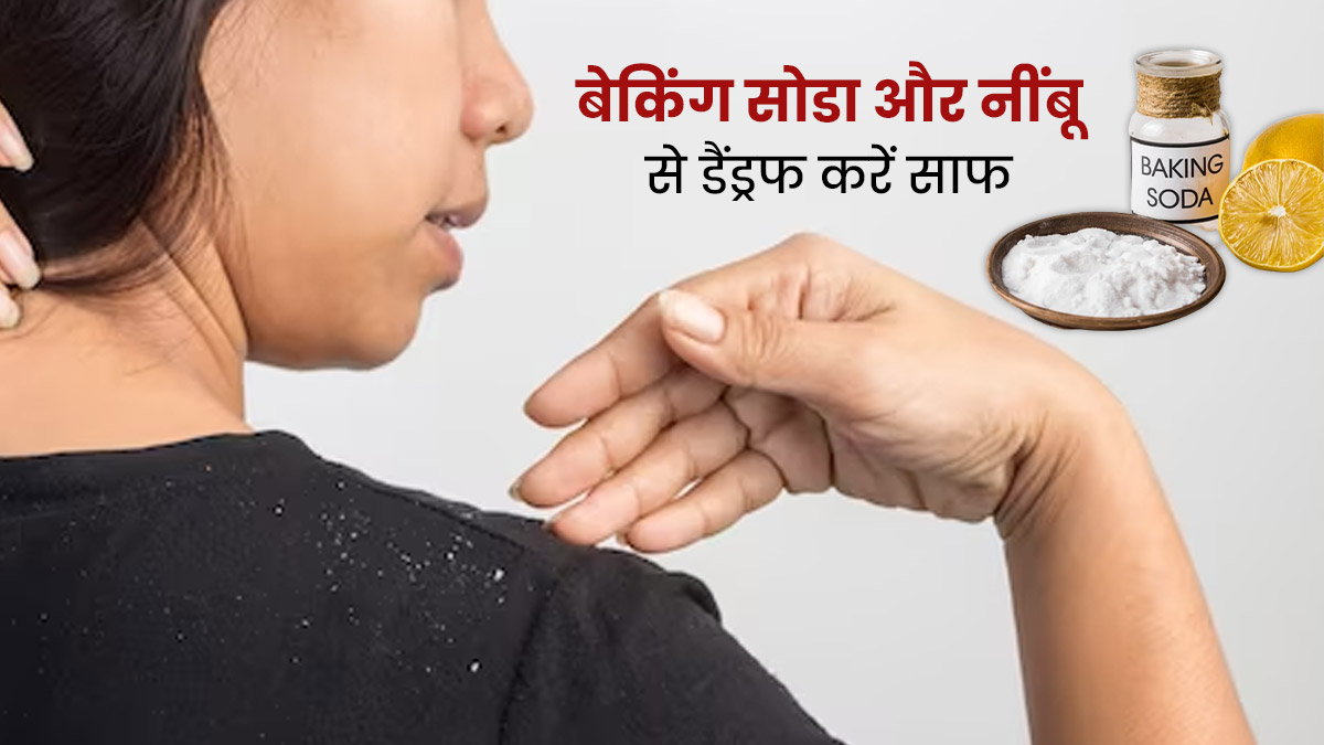 डैंड्रफ से छुटकारा पाने के लिए इस तरह करें बेकिंग सोडा और नींबू का प्रयोग, स्कैल्प की एलर्जी भी होगी दूर
