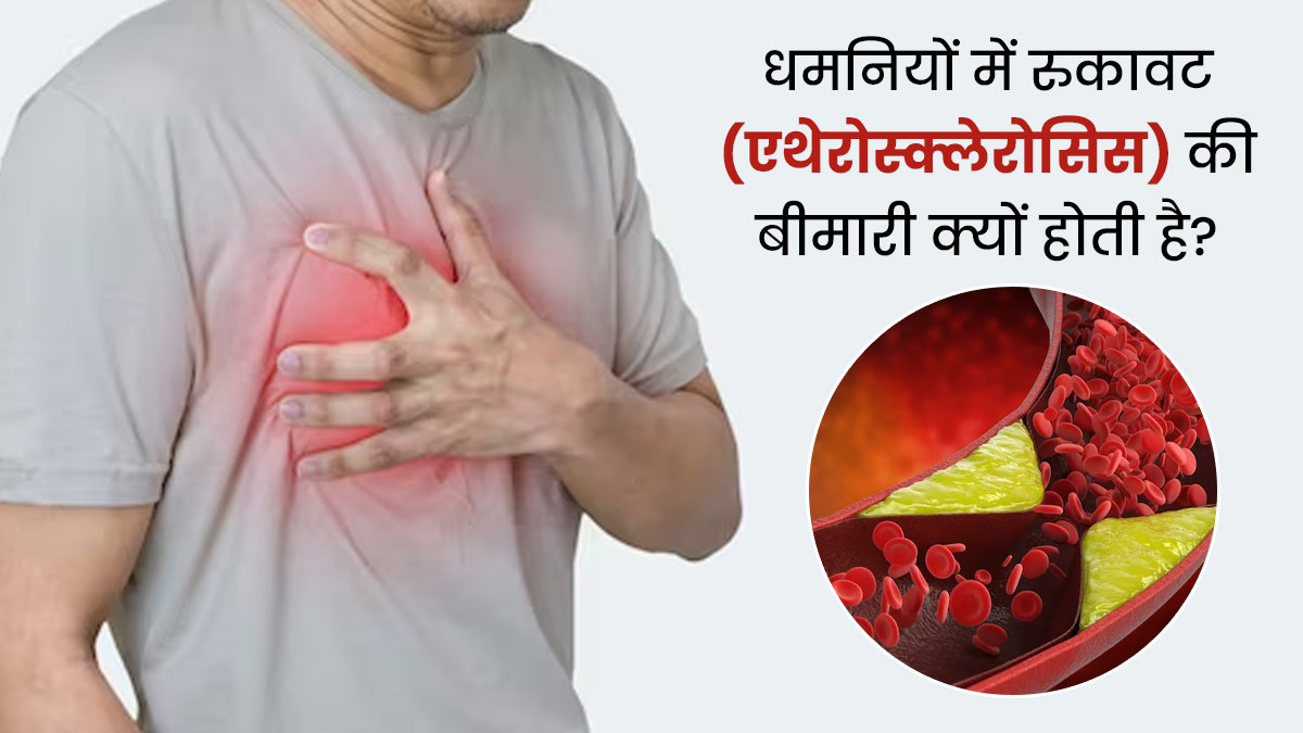 एथेरोस्क्लेरोसिस (धमनियों में रुकावट) की बीमारी क्यों होती है? डॉक्टर से आसान भाषा में समझें  