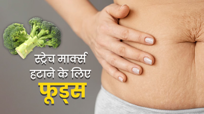 स्ट्रेच मार्क्स हटाने में मदद कर सकते हैं ये 5 फूड्स, डाइट में करें शामिल