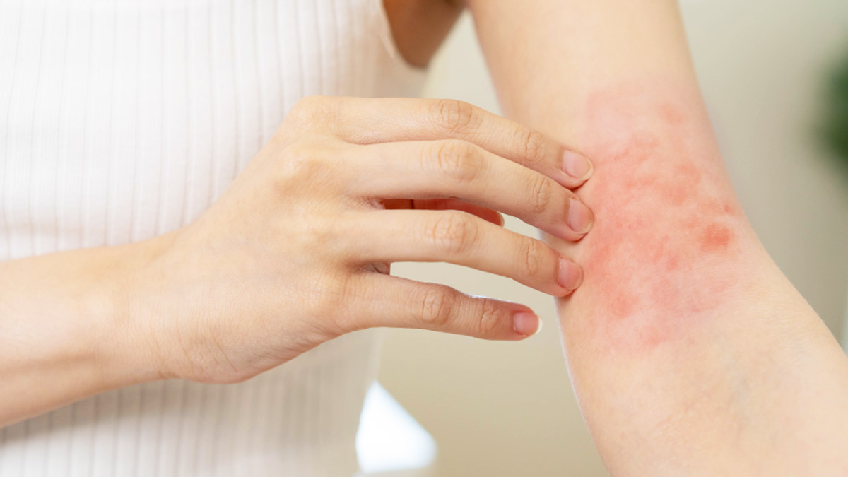 skin rashes in monsoon