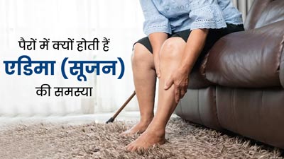 पैरों में एडिमा (सूजन) की समस्या क्यों होती है? जानें इसके 5 कारण