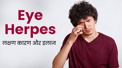 आंख में हर्पीज क्यों होता है? जानें इसके लक्षण, कारण और इलाज