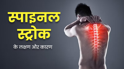 गर्दन और कमर में अचानक होने वाला दर्द हो सकता है स्पाइनल स्ट्रोक का संकेत, जानें लक्षण, कारण और इलाज 