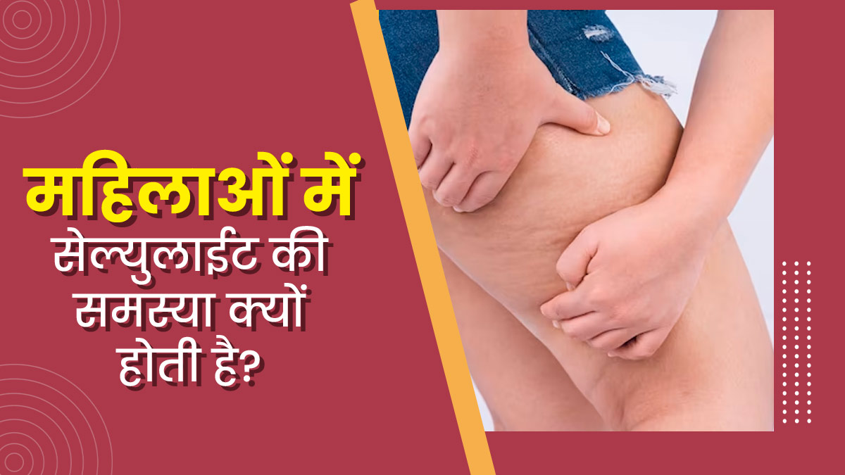 सेल्युलाईट (त्वचा के नीचे जमा फैट) की समस्या क्यों होती है? जानें इसके कारण और इलाज 
