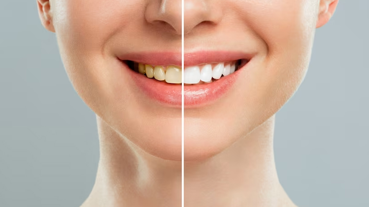 Lemon Juice, Mustard Oil And Salt Toothpaste