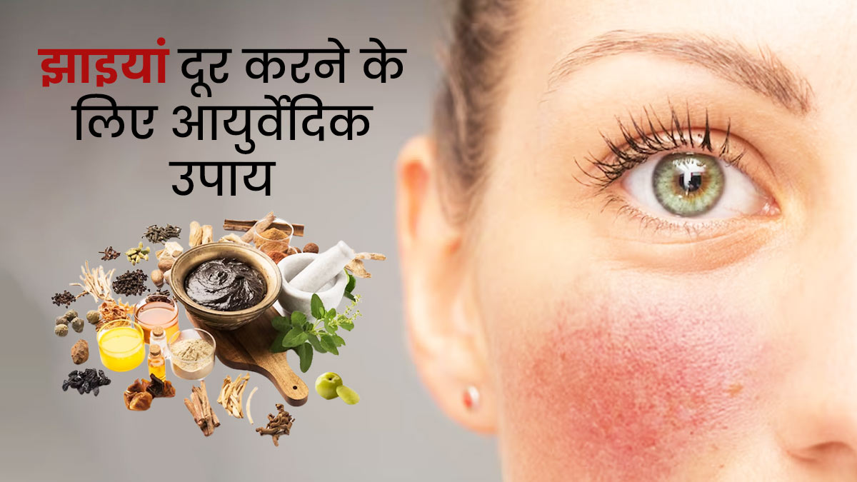 झाइयां दूर करने के लिए अपनाएं ये आयुर्वेदिक उपाय, मिलेगी फ्रेकल्स फ्री स्किन