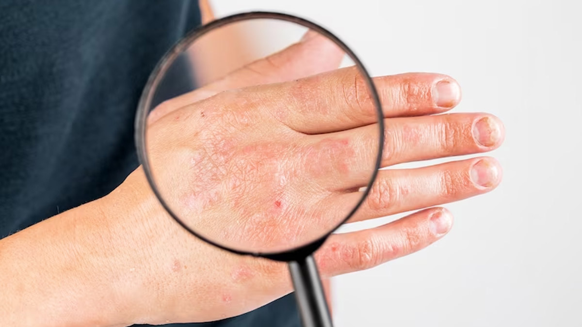 Skin Infection