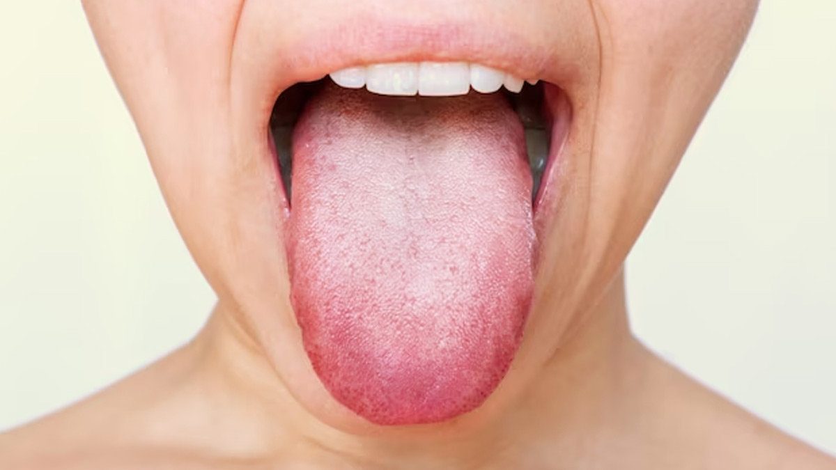 Swollen Taste Buds Possible Causes That Can Lead To The Condition   Main Swollen 