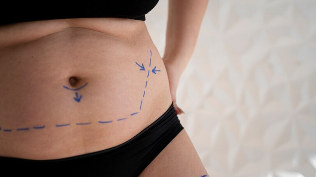 A Treatment for Post-Partum Belly Pooch