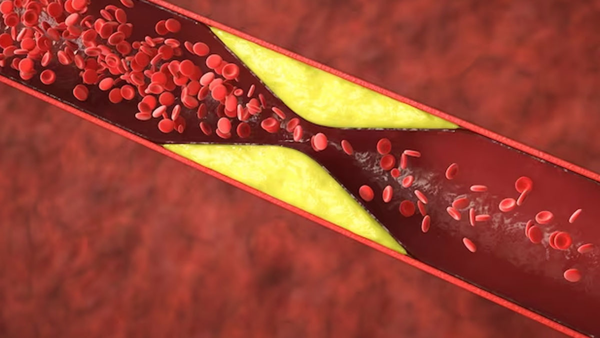Tips To Prevent From Arteries Getting Blocked In Hindi