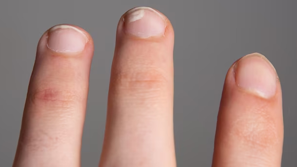 White nails or leukonychia - causes and treatment - YouTube