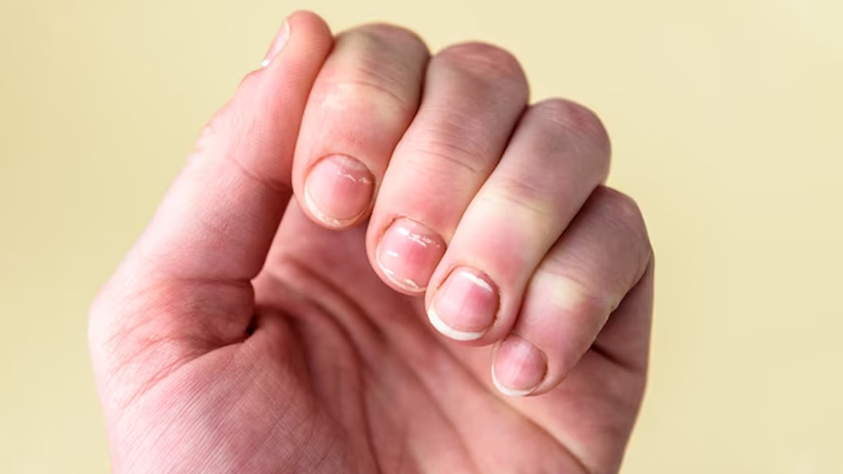 White spot on the nails tell five things about your health