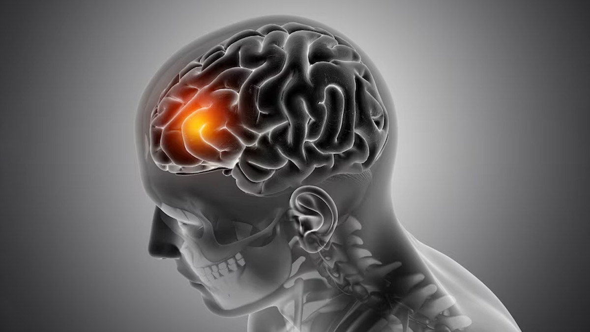 Meningitis-Headaches