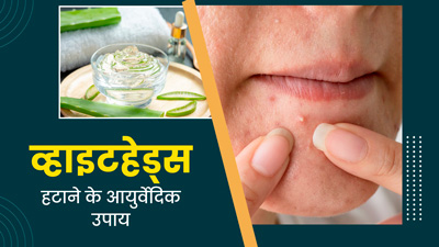 चेहरे के व्हाइटहेड्स हटाने लिए आजमाएं ये 5 आयुर्वेदिक उपाय, त्वचा दिखेगी साफ