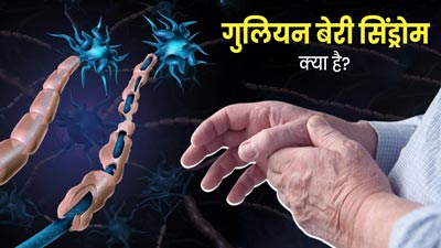 गुलियन बेरी सिंड्रोम के कारण लोग हो रहे पैरालाइज, पेरू में लगी हेल्थ इमरजेंसी, जानें क्या है यह बीमारी   