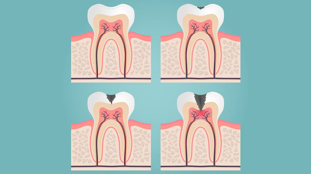 cavity tooth symptoms 