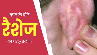 कान के पीछे क्‍यों होते हैं रैशेज? जानें कारण और घरेलू उपाय 