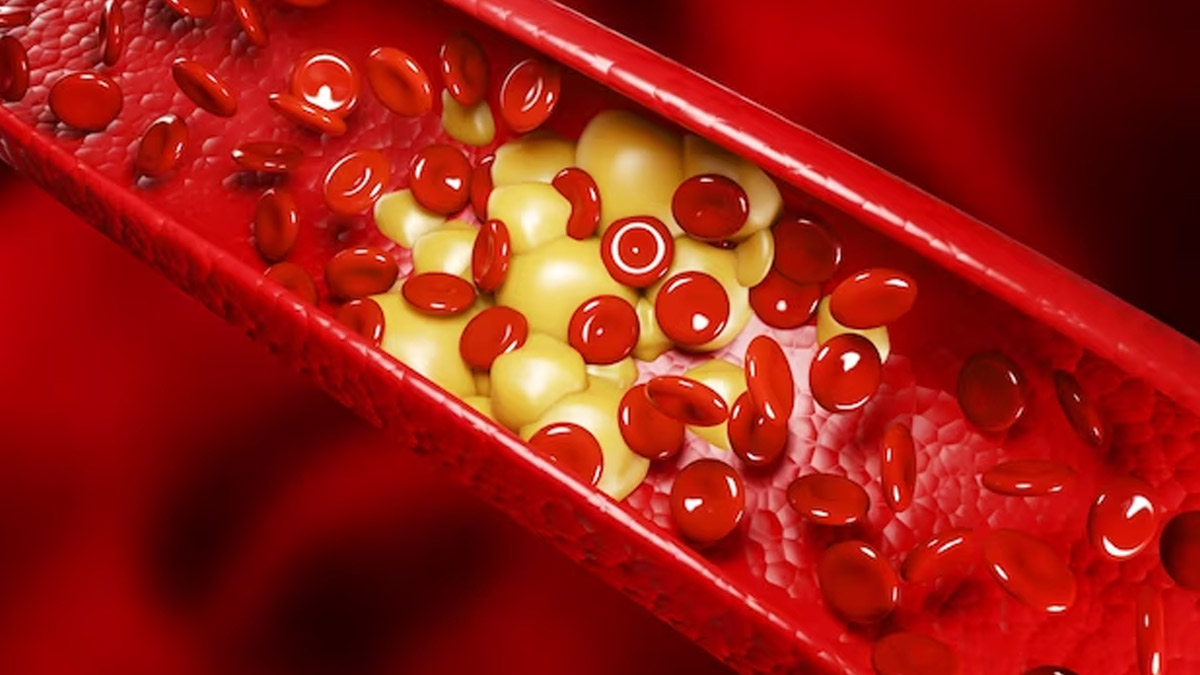 block arteries symptoms