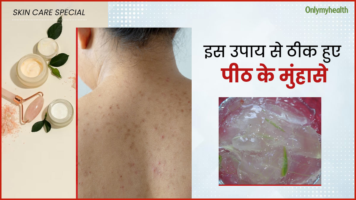 बैक एक्ने से छुटकारा पाने के लिए मैंने आजमाया यह घरेलू नुस्खा, दाग-धब्बे भी हुए साफ