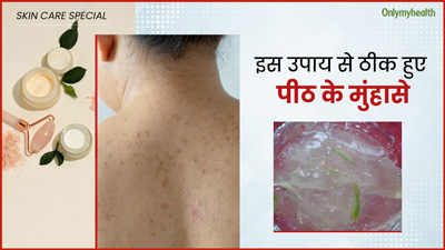 बैक एक्ने से छुटकारा पाने के लिए मैंने आजमाया यह घरेलू नुस्खा, दाग-धब्बे भी हुए साफ