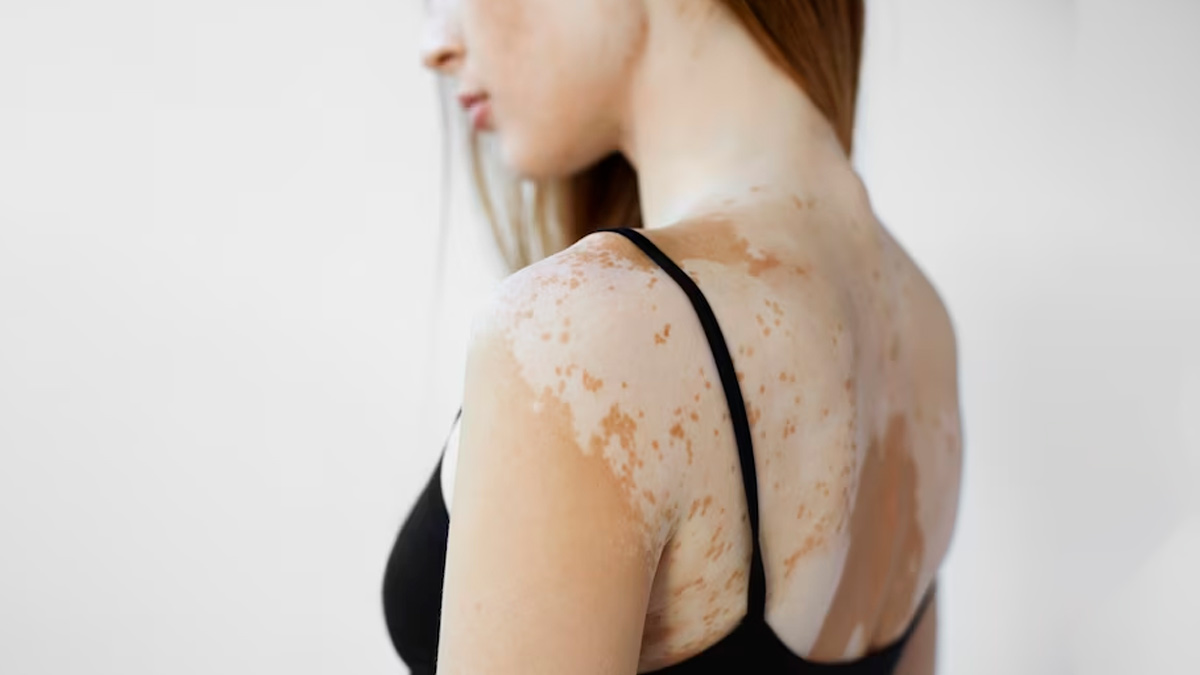 Breaking Down The Myths: Understanding Vitiligo And Promoting Inclusivity
