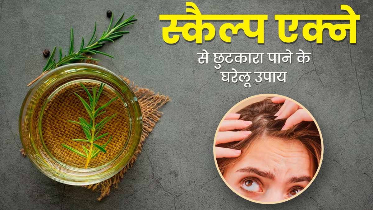 मानसून में स्कैल्प एक्ने से हैं परेशान? छुटकारा पाने के लिए आजमाएं ये 5 घरेलू उपाय
