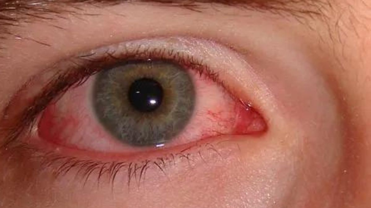 eye