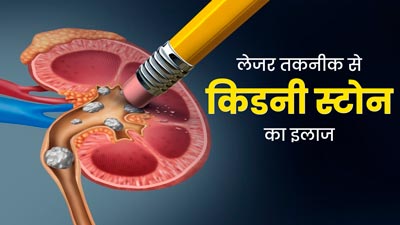 लेजर सर्जरी से किया जा सकता है किडनी स्टोन का इलाज, डॉक्‍टर से जानें इसकी पूरी प्रक्र‍िया 