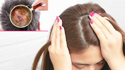 मानसून में स्कैल्प पर हो गया है फंगल इंफेक्शन, तो बचाव के लिए अपनाएं ये 4 उपाय
