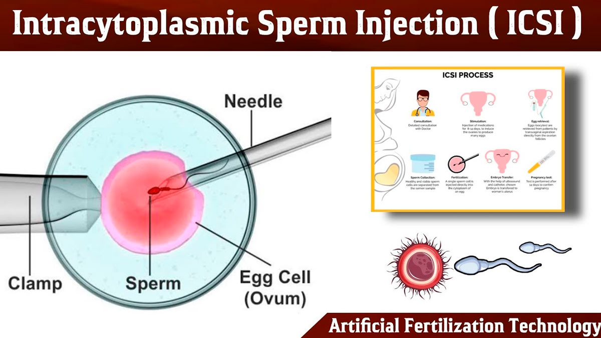 Intracytoplasmic Sperm Injection