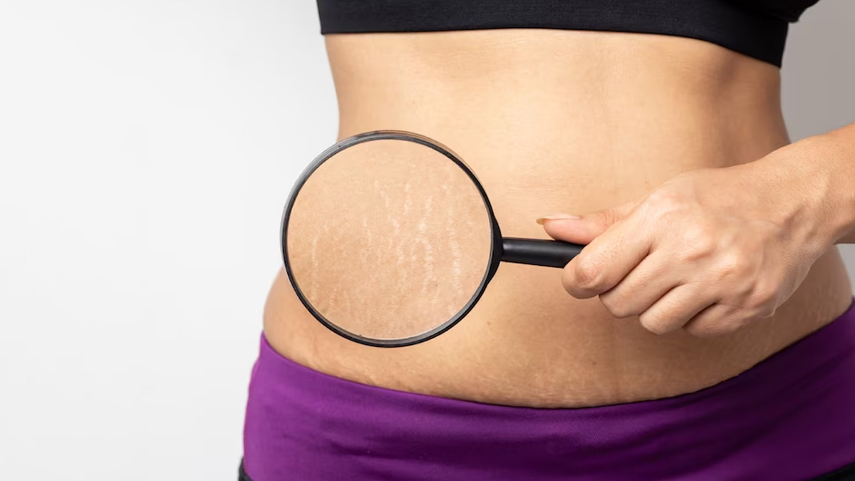 Decoding Stretch Marks:  Expert Explains The Causes And How To Deal With It
